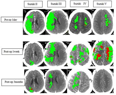Evaluation of Revascularization in Different Suzuki Stages of Ischemic Moyamoya Disease by Whole-Brain CT Perfusion